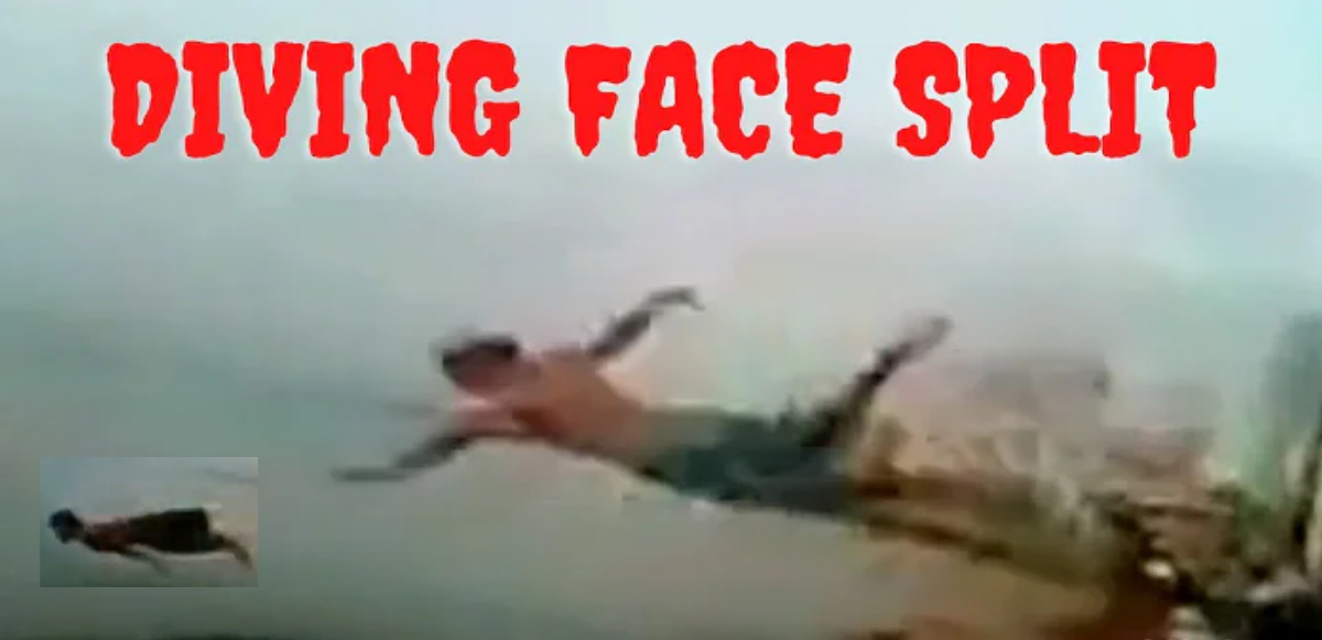 Split Face Diving Accident Reddit